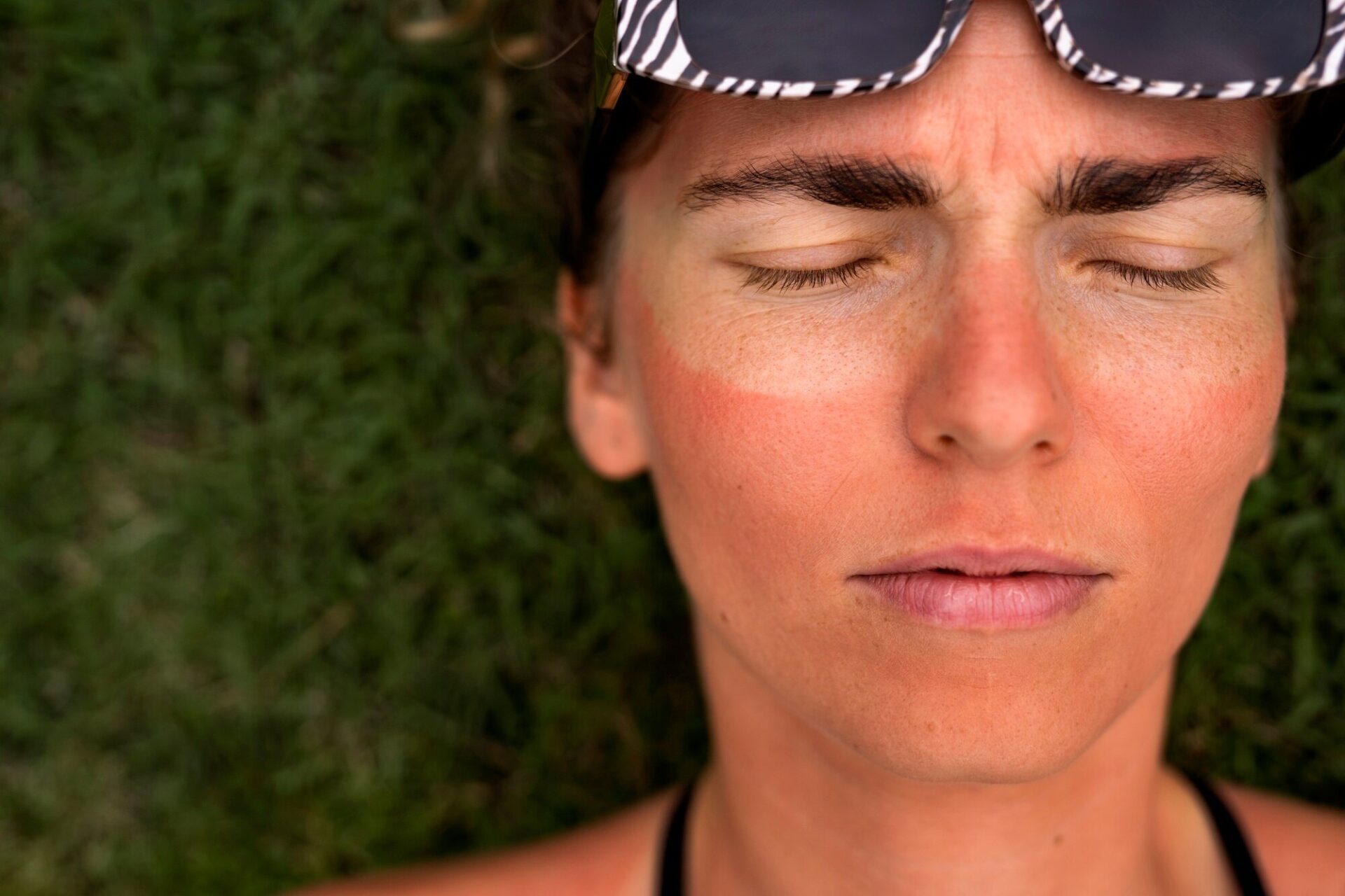 Benefits of the sauna for skin helps accelerate sunburn recovery